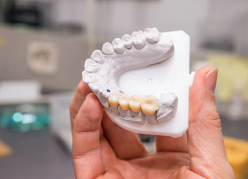 What is the price of dental implants in 2022?