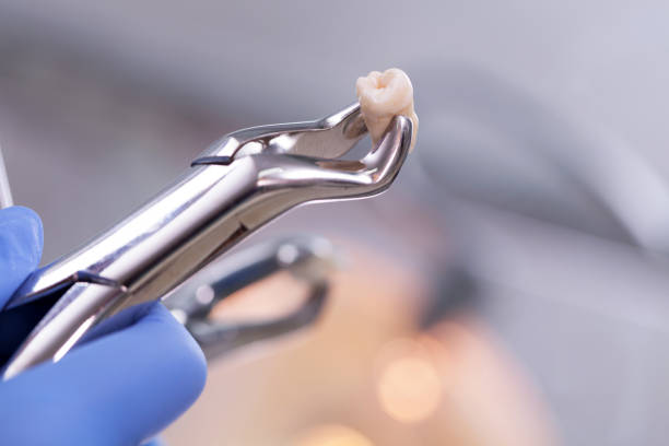 How much does tooth extraction cost?
