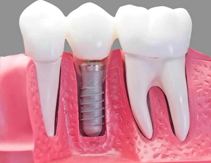 Single Tooth Implants Dental Bridges Market - Forecast 2029