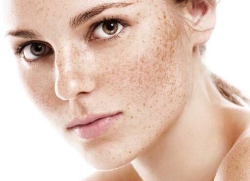 Learn why your skin is more Pigmentation and how to treat it